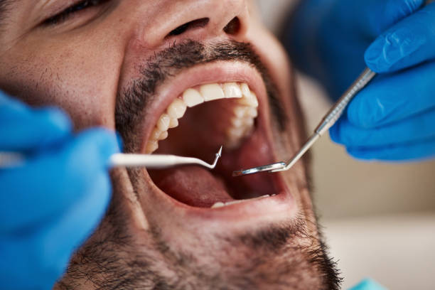 Best Emergency Tooth Extraction in Shenandoah Farms, VA
